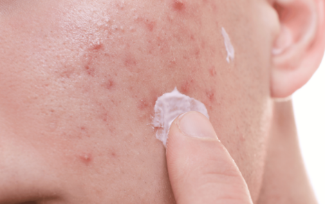 The phage story: the natural solution for blemish-prone skin